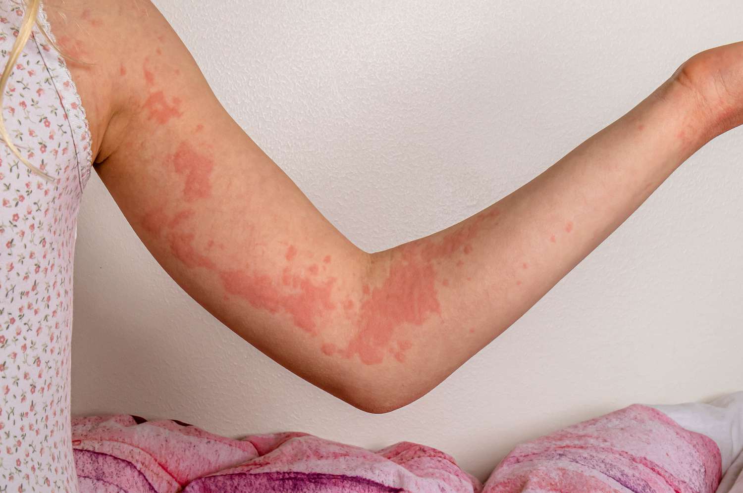 Drug Rashes (Ruam Karena Alergi Obat)